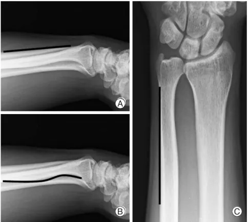 Fig. 3. (A) Dorsal border of the distal ulna is straight and provides good surface for the plate sitting