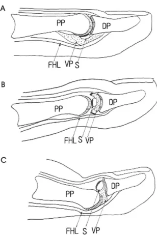Figure 1. (A)  The  normal  anatomy  of  the  interphalangeal(IP)  joint  of  a  great  toe