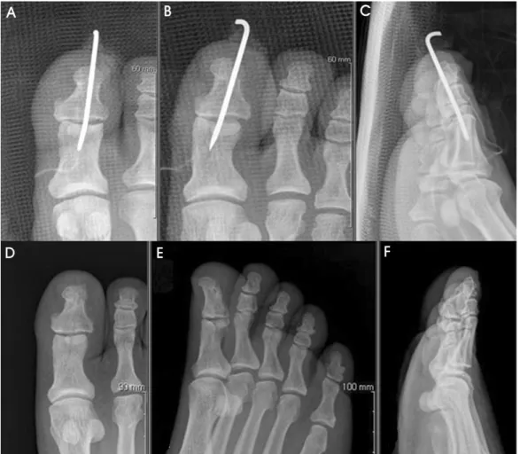 Figure 3. Intraoperative  photograph  shows  interposition  of  sesamoid  within  interphalangeal  joint.