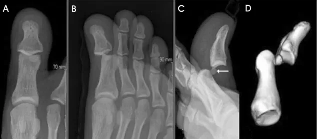 Figure 5. Preoperative  radiographs  and  3D-CT  show  interphalangeal  dislocation  of  great  toe  with  dorsal  displacement  of  sesamoid