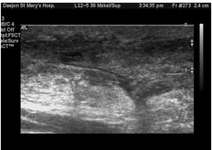 Figure 3. Operative  finding  of  ragged  margin  and  6  cm  gap  formation  of  reruptured  Achilles  tendon  at  original  tear  site.