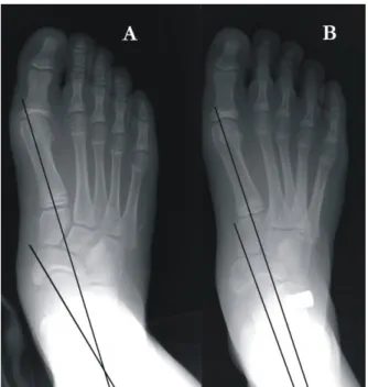 Figure  2.  (A)  AP  preoperative  x-ray  in  standing  position.  Note  the  forefoot  abduction  about  29°  talo-1 st   metatarsal  angle