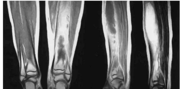 Fig. 1. Bone scan with Tc 99 increased hot uptake in metaphysis and diaphysis of left tibia with intact epiphysis.
