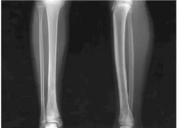 Fig. 5. Last follow-up radiographs of left tibia showed no evi- evi-dence of active osteomyelitis.