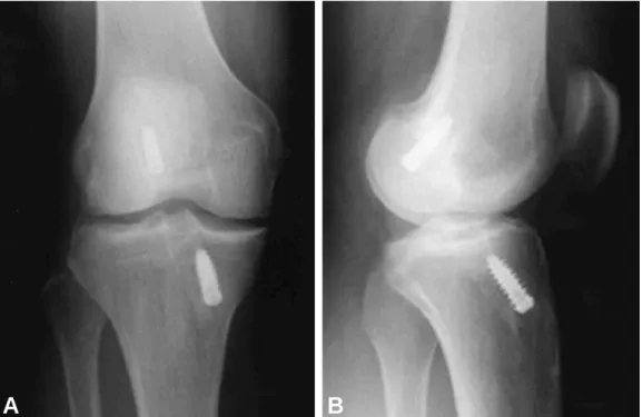 Fig. 2. (A-B) AP and lateral plain radiographs taken 11 years postoperatively. Both radiographs demonstrate migration of the femoral interference screw into the posterior compartment.