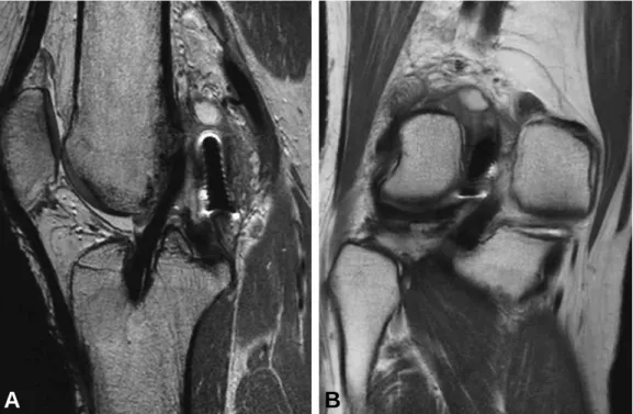 Fig. 3. (A-B) Sagittal and coronal MRI findings demonstrate a homogenously low signal intensity of the reconstructed and well- well-maintained ACL