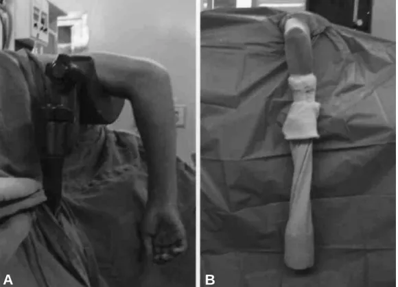 Fig. 1. Making position for operation: (A) Under the general anesthesia or axillary block, the patient was placed in the lateral decubi- decubi-tus position with tourniquet was applied highly around the arm, and then the arm was placed over a bolster attac