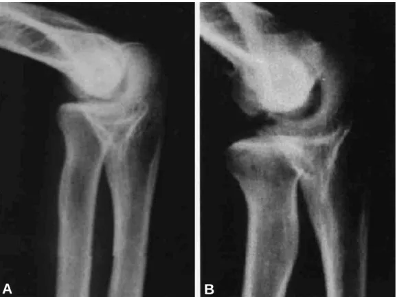 Fig. 2. X-ray findings of distraction: (A) Before distraction, the joint space was still narrow