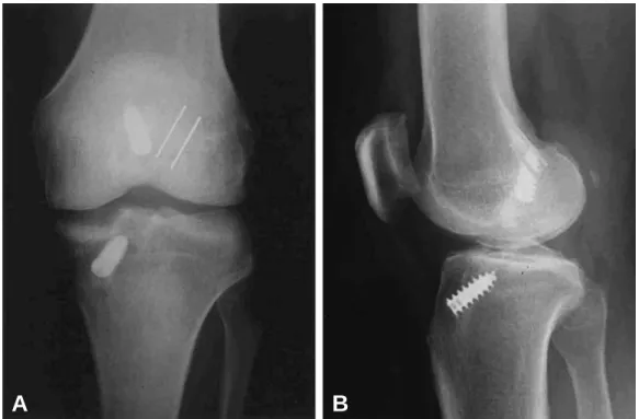 Table 4. Cause of failure after primary ACL surgery