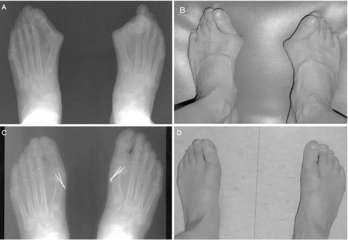 Figure 1. A  67-year-old  woman  with  bilateral  hallux  valgus  deformity,  who  underwent  distal  chevron  osteotomy  with  lateral  soft  tissue  release  of  both  feet