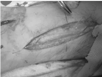 Figure 2. The  saphenus  vein  is  dissected  through  separate  longitudinal  incision.