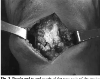 Fig. 4. Demonstration of Achilles tendon allograft augmenta- augmenta-tion by rectangular shape in acute patellar tendon tear.