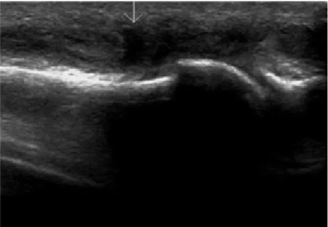 Figure 1. We  found  the  defect  of  the  extensor  hallucis  longus  (arrow)  in  sonograph
