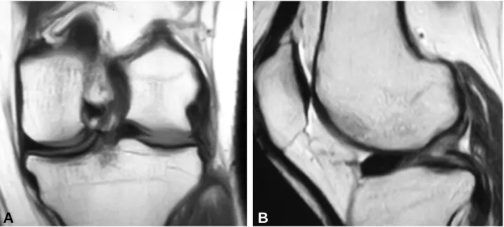 Fig. 4. Arthroscopic view of the left knee shows a complete discoid meniscus with no posterior attachment.