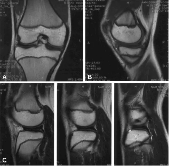 Fig. 1. (A) Midcoronal MR image of the right knee showing the discoid medial meniscus with massive horizontal tear and intact incomplete type lateral discoid meniscus (B) Sagittal MR image shows the complete medial discoid meniscus with  intra-meniscal sig