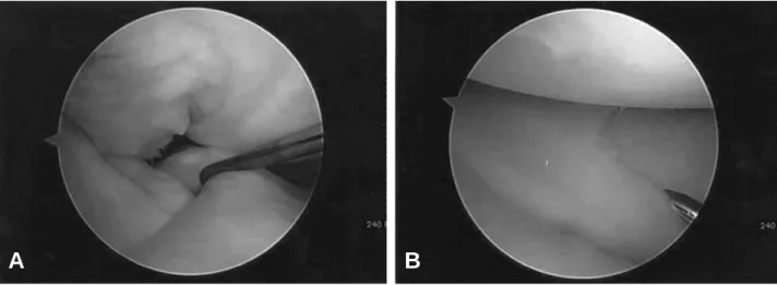 Fig. 2. (A) Arthroscopic finding of the medial compartment of the right knee shows complete medial discoid meniscus