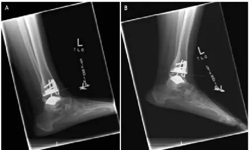 Figure 1. Full  dorsiflexion  and  full  plantar  flexion  weight  bearing  images  show  that  the  tibia  component  inferior  surface  used  as  a  reference  line