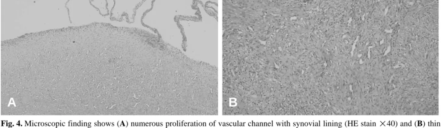 Fig. 4. Microscopic finding shows (A) numerous proliferation of vascular channel with synovial lining (HE stain ×40) and (B) thin walled vascular space of varying sizes lined with a single layer of endothelial cells(HE stain ×100).