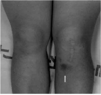 Fig. 1. Clinical photograph of both knee of patient at 3 years follow up after ACL reconstruction with autogenous bone-patella tendon-bone and tibial &amp; femoral fixation with bioabsorbable interference screws