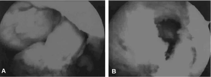 Fig. 4. In the arthroscopic finding, severe synovitis at tibial and femoral attatchment site of graft (A) and bone defect in femoral tun- tun-nel were visible (B)