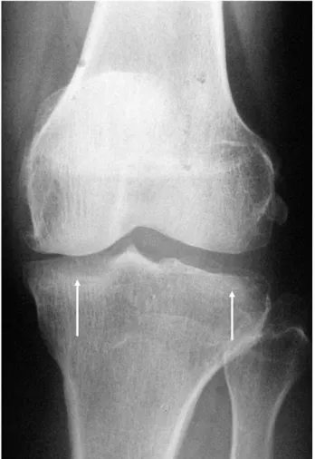 Table 3. Type of meniscal tear