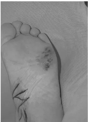 Figure 1. This  photograph  shows  malignant  melanoma  on  lateral  plantar  surface  of  the  forefoot.