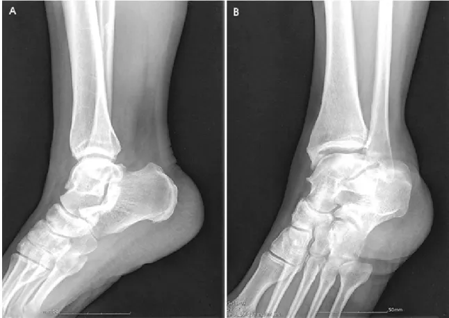 Figure 2. Standard  lateral  radiograph  (A)  and  Oblique  radiograph  (B)  of  an  ankle