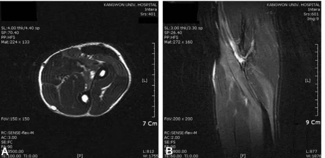 Fig. 1. Axial T2-weighted image (A) and coronal fat suppression T2-weight image (B). The MRI was seen intermedi- intermedi-ate signal intensity on extensor carpi radialis, pronator teres and flexor carpi radialis