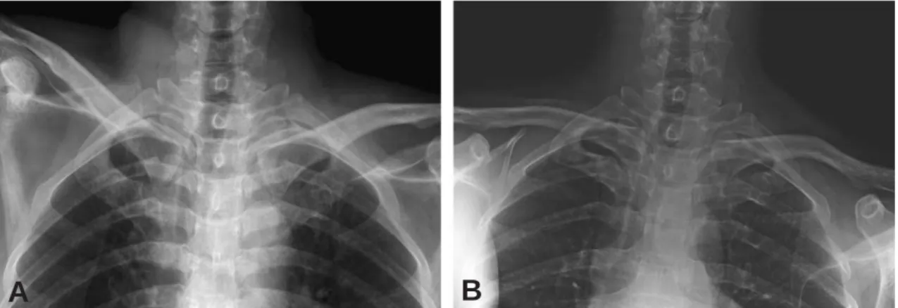 Fig. 2. Hot uptake on left sternoclavicular joint is found on routine bone scan.