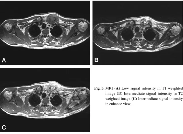Fig. 3. MRI (A) Low signal intensity in T1 weighted image (B) Intermediate signal intensity in T2 weighted image (C) Intermediate signal intensity in enhance view.