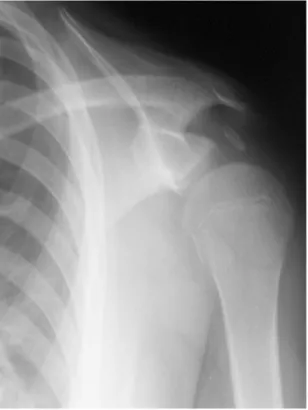 Fig. 1. Left shoulder AP view shows a bony fragment between acromion and greater tubercle.