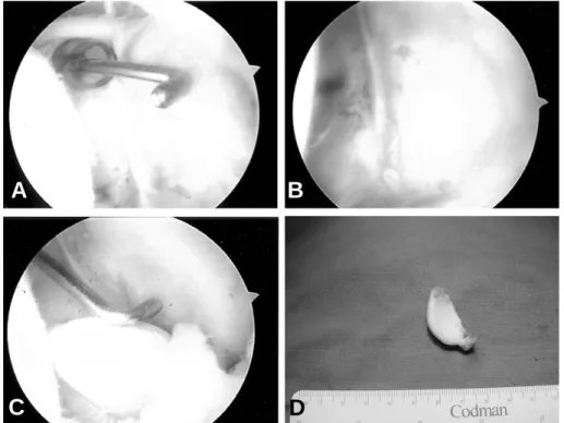 Fig. 2. (A) T1-weighted coronal image shows bony defect in the antero-inferior glenoid