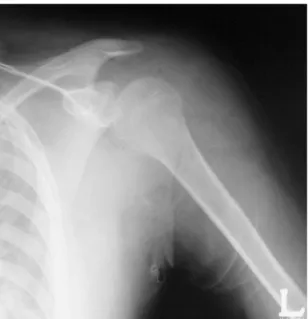 Fig. 4. Postoperative shoulder AP view shows no bony fragment in the shoulder joint.
