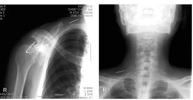 Fig. 1. Simple radiograph of the right shoulder shows a broken Kirschner wire at acromioclavicular joint and a broken K-wire migrated to the neck.