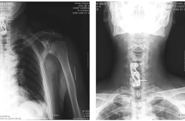 Fig. 3. Plain X-ray of the left shoulder shows three Kirschner wires at the left acromioclavicular joint and two broken Kirschner wires to lateral aspect of the left arm and to the neck.