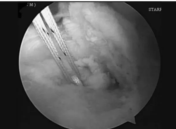 Fig. 2. Another horizontal mattress loop(arrow) was made at 10~15 mm medial to edge of cuff tendon.