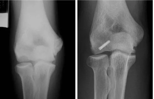Fig. 5. Radiographs demonstrating fixation with headless screw of lesion site.