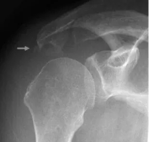 Fig. 7. Arthroscopic photograph of the shoulder confirms the presence of a diffuse and villous form of PVNS and rotator cuff tear in consistent with MR finding.