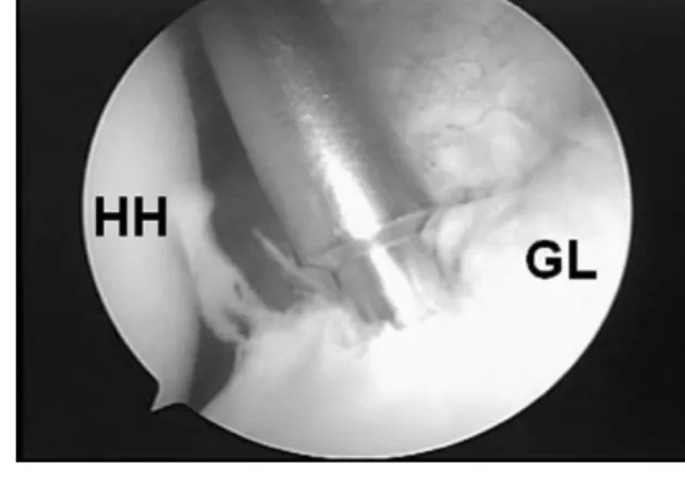 Fig. 2. Punching to make a bone hole at 7 O’Clock posi- posi-tion of the glenoid rim in left shoulder.