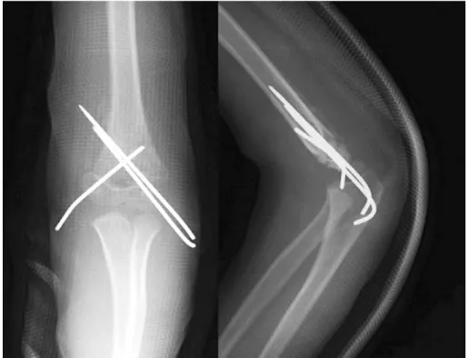 Fig. 2.  : K-wire fixation was done at medial and lateral side after reduction