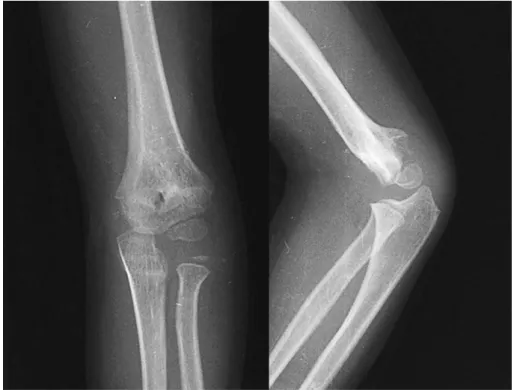 Fig. 3.  : Postoperative radiographs show fair case based on Flynn’s evaluation.