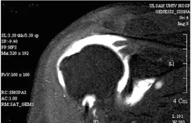 Fig. 1. Preoperative MRI in the Rt shoulder demon- demon-strates massive full-thickness tear of  supraspina-tus tendon, right and severe fatty atrophy.
