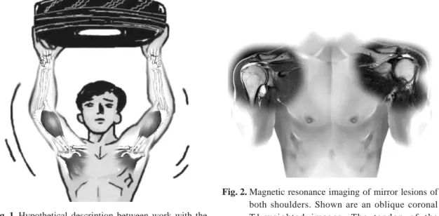 Fig. 2. Magnetic resonance imaging of mirror lesions of both shoulders. Shown are an oblique coronal T1-weighted images