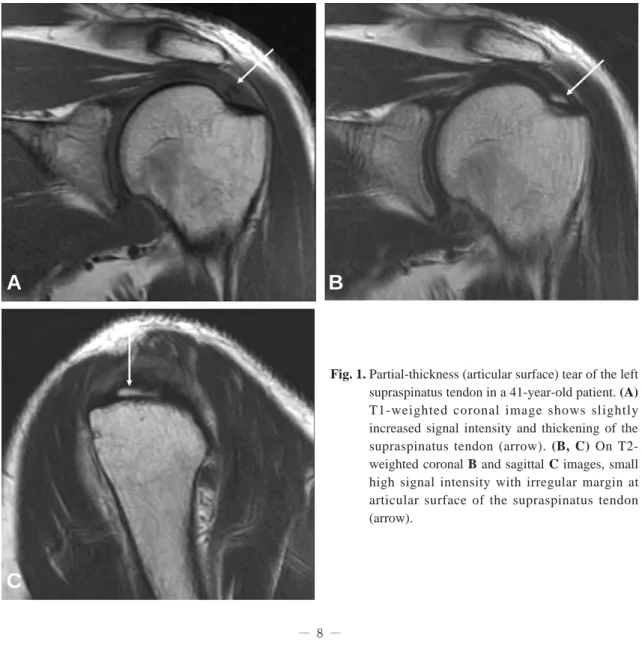 Fig. 1. Partial-thickness (articular surface) tear of the left supraspinatus tendon in a 41-year-old patient
