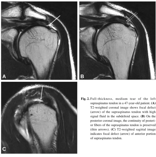 Fig. 2. Full-thickness, medium tear of the left supraspinatus tendon in a 47-year-old patient