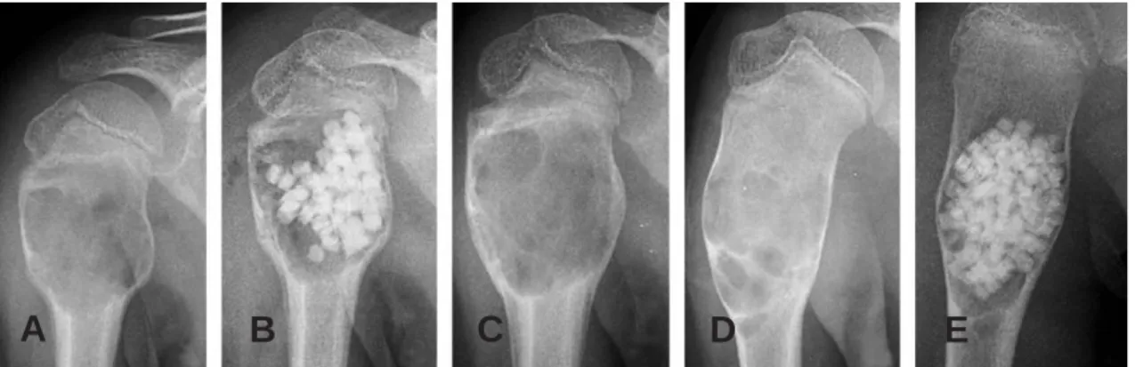 Fig. 3. Simple bone cyst of proximal humerus in 10-year-old girl. (A) Preoperative AP radiograph shows bone loss in proximal humerus