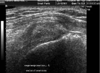 Fig. 8. Behind structure of the ganglion shows high-echo image. 
