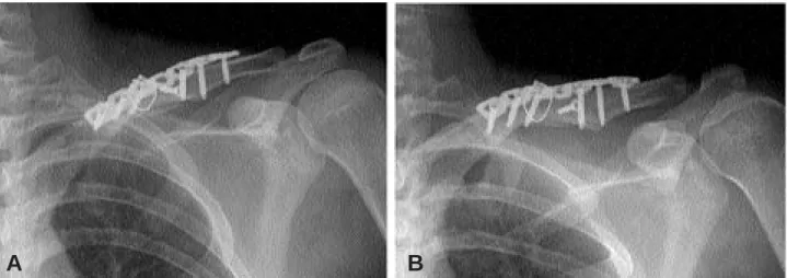 Fig. 2. (A-B) The postoperative radiograph shows a satisfactory reduction after internal fixation with locking compression plate, and displacement and angulation were corrected.