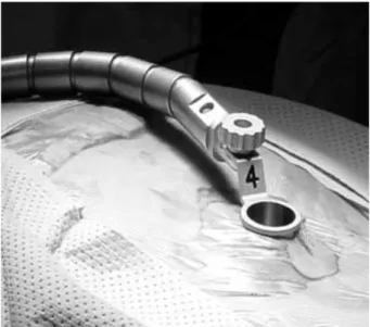 Fig. 4. Decompression was completed through tubular retractor.