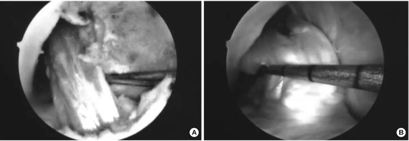 Fig. 2. (A) 29-year-old man with a postoperative arthroscopic finding of anterior cruciate ligament reconstruction with 4-stranded double loop hamstring tendon in the left knee
